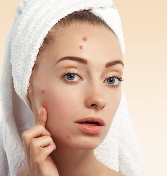 closeup-young-woman-with-towel-head-pimples-face (1)